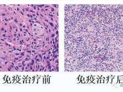 非小细胞肺癌新辅助治疗,肺癌新辅助免疫治疗