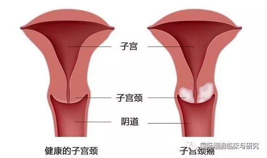 健康的子宫和子宫颈癌