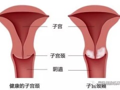 宫颈癌新药,抗体偶联药Tisotumab Vedotin疗效强劲