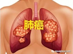 史无前例:肺癌新辅助治疗,肺癌新辅助免疫治疗药物O药显著改善患者生存情况