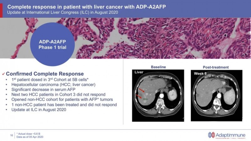 ADP-A2AFP治疗肝癌前后对比