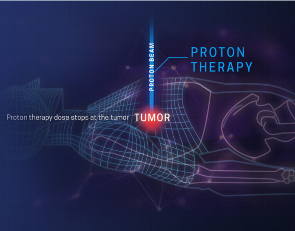 质子治疗的优势