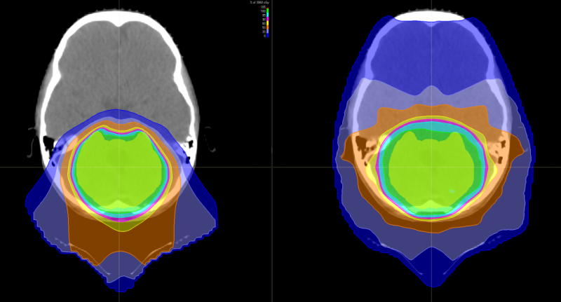 脑瘤质子治疗和传统放疗照射面积对比