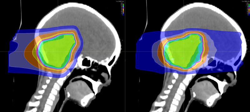 脑瘤质子放疗和传统放疗辐射剂量对比