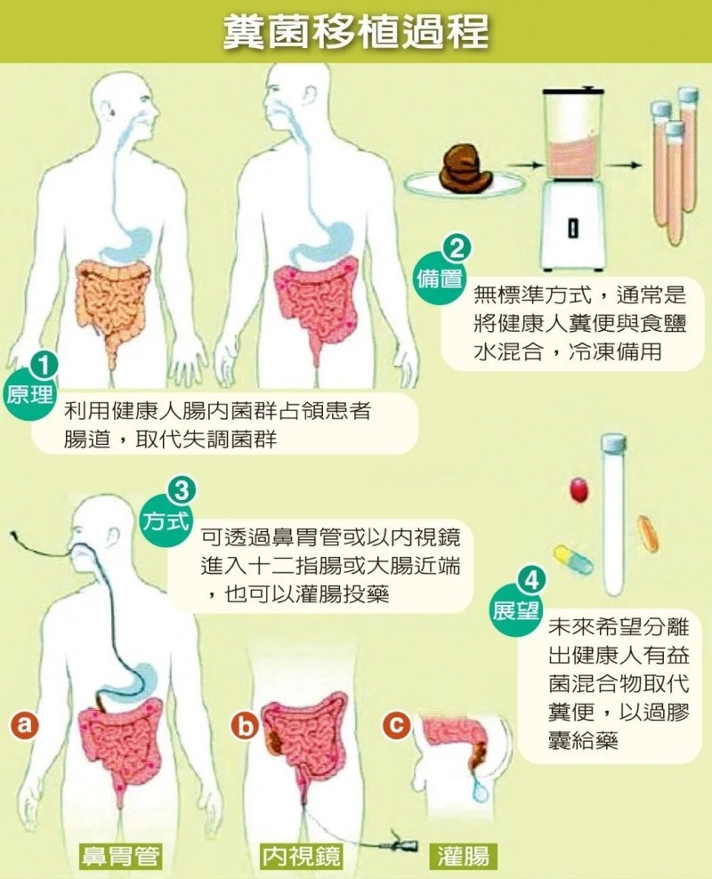 粪菌移植过程