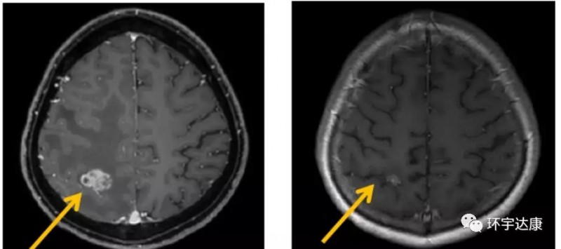恩曲替尼治疗肺癌脑转移治疗前后对比