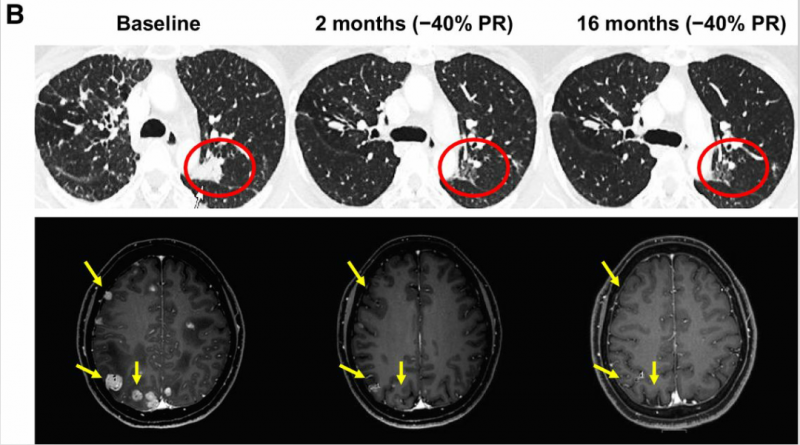 瑞波替尼治疗肺癌脑转移后肿瘤缩小40%