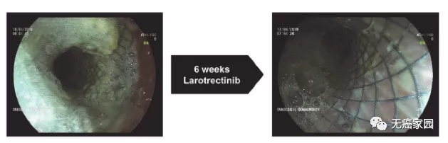 患者食管支架治疗前用拉罗替尼及治疗后6周食管胃十二指肠镜检查结果