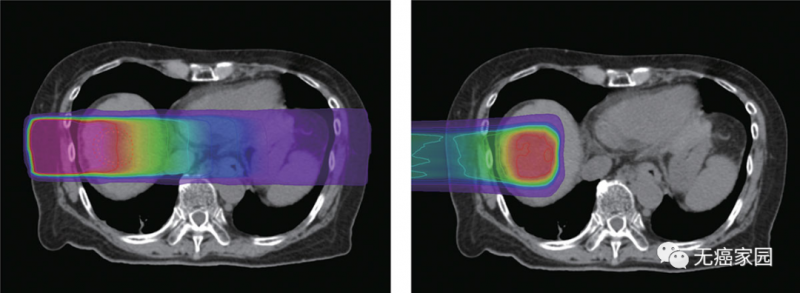 传统放疗和质子治疗照射面积对比
