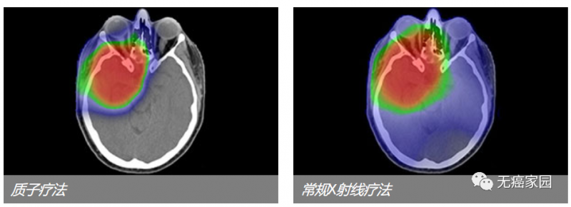 质子治疗和传统放疗放射剂量对比