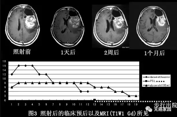 脑瘤硼中子治疗案例