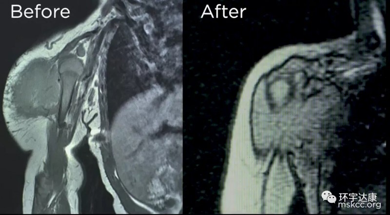 儿童肿瘤患者蕾哈娜CT影像