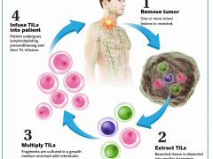 癌症肿瘤治疗新方法,肿瘤新疗法,肿瘤新技术,肿瘤浸润淋巴细胞TILs个性化免疫治疗有望在2022年上市