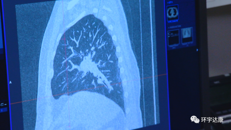 肺癌患者TILS治疗后的CT影像