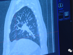 肺癌新疗法,肺癌新技术,首位接受新型细胞免疫疗法TILs治疗的晚期肺癌患者,如今已重回正常生活