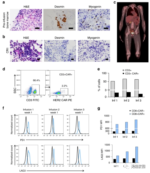 横纹肌肉瘤CAR-T疗法治疗效果
