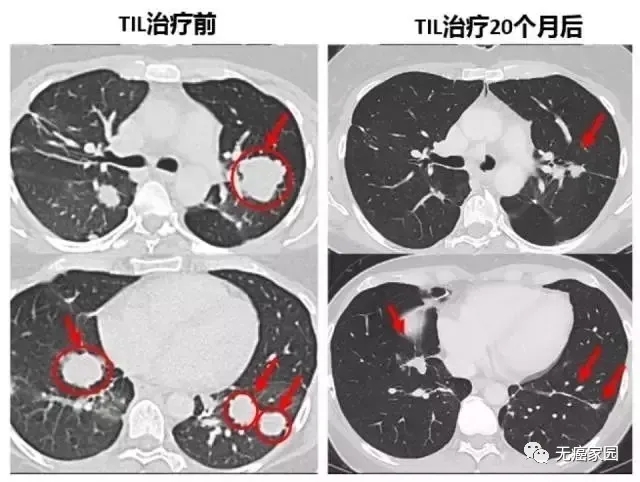 肺部肿瘤TIL疗法治疗前后对比