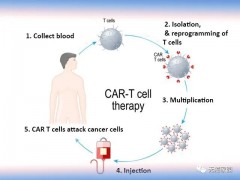CAR-T细胞疗法,CAR-T细胞治疗,CAR-T免疫疗法,CAR-T细胞免疫疗法治疗晚期癌症肿瘤4年总生存率达44%