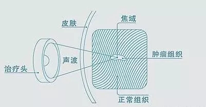 海扶刀治疗原理