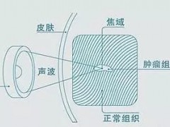 什么是海扶刀手术,海扶刀适应症,海扶刀治疗原理,海扶刀手术后注意事项