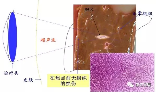 HIFU技术聚焦的是超声波