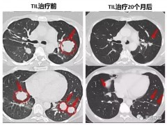 自体免疫细胞疗法治疗技术,首位接受自体免疫细胞回输肿瘤浸润淋巴细胞TILS疗法的超级幸存者至今幸存11年