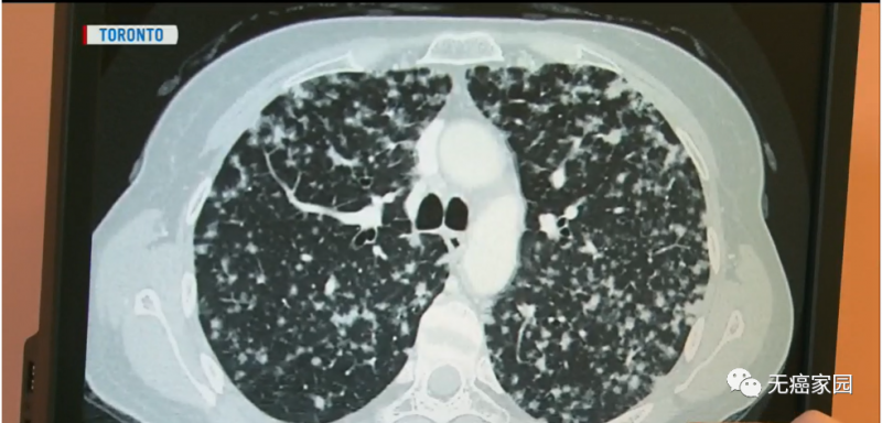 肺癌影像图