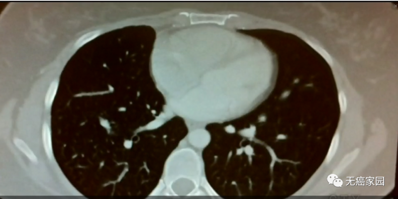 肺癌靶向药治疗三周后影像图