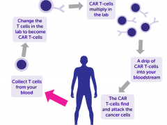 淋巴瘤CAR-T细胞免疫疗法,CAR-T细胞免疫治疗,CAR-T临床试验