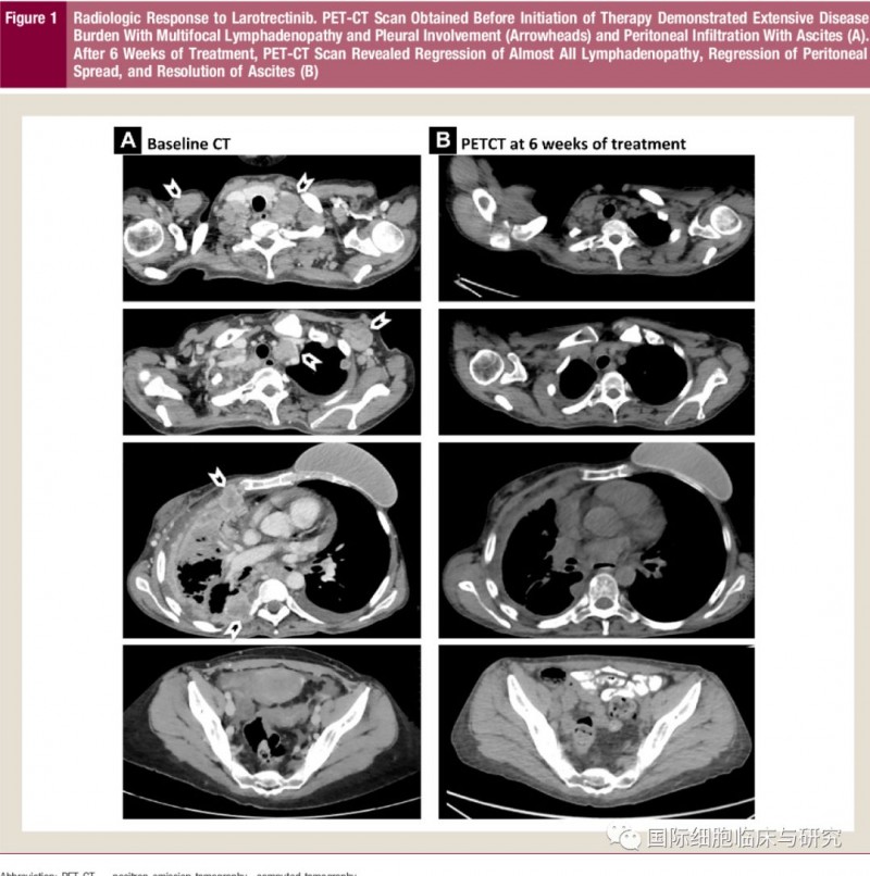 分泌性乳腺癌患者治疗前CT及拉罗替尼治疗6周后PETCT对比图