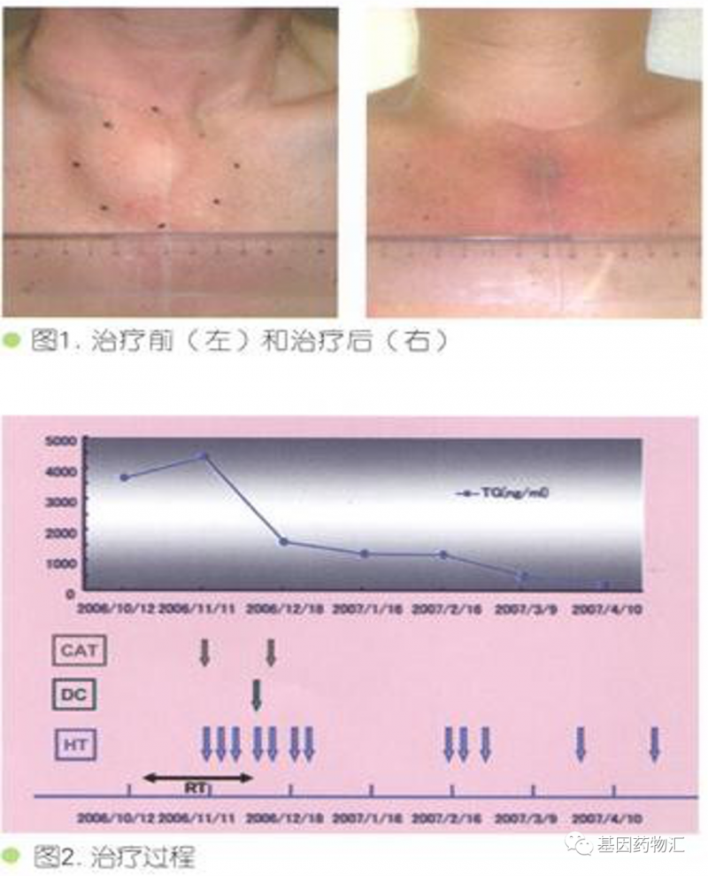 热疗联合细胞免疫治疗