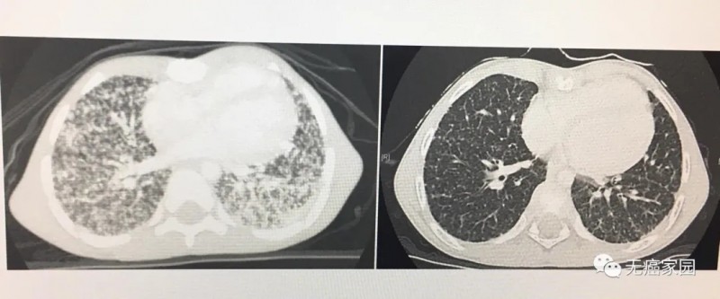 拉罗替尼治疗甲状腺癌前后对比