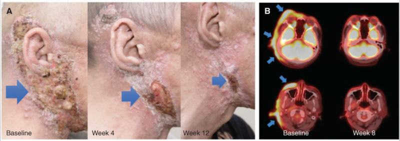 Repotrectinib治疗NTRK融合的分泌性唾液腺癌效果