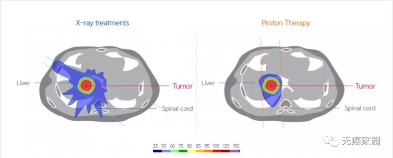 X射线与质子疗法治疗肝癌的比较