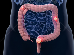 结直肠癌靶向药物,NTRK靶向药拉罗替尼成为抗癌新星