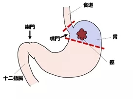 日本ESD胃癌手术切除面积