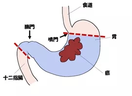 普通胃癌手术切除面积