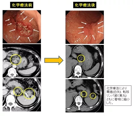 胃癌术新前辅助治疗