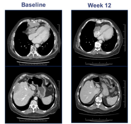 ADP-A2M4 T细胞治疗晚期滑膜肉瘤前后CT图像对比