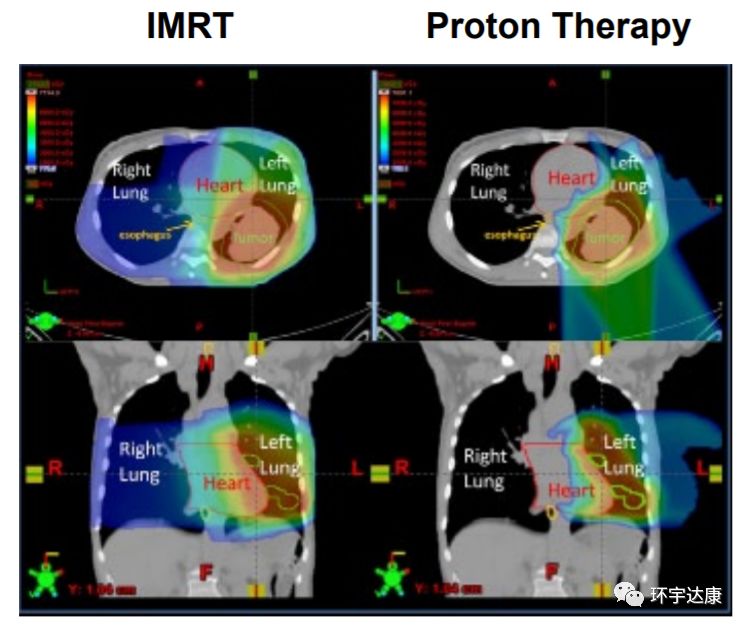 质子治疗传统放疗和质子治疗对比