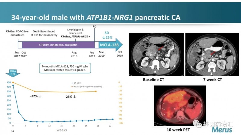 MCLA-128治疗胰腺癌5个月后