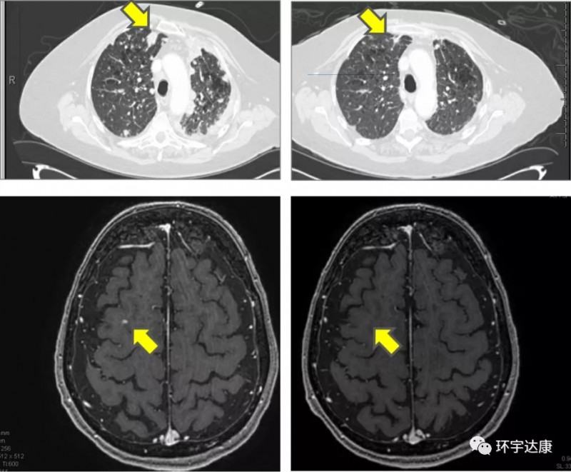 非小细胞肺癌脑转移MRTX849治疗前后对比