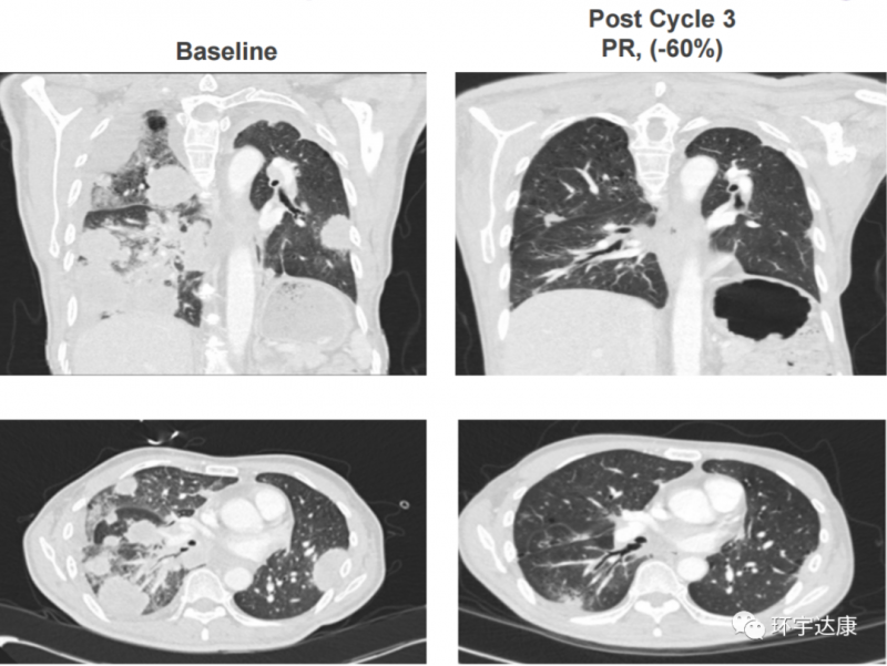 Adagrasib(MRTX849)联合TNO-155治疗非小细胞肺癌一个周期前后对比