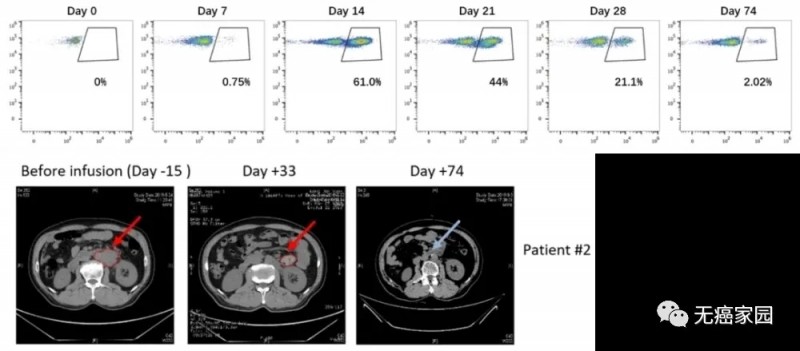 新型CAR-T在患者2体内的扩增(上) 和抗肿瘤能力(下)