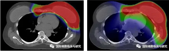 乳腺癌质子治疗和传统放疗放射剂量对比