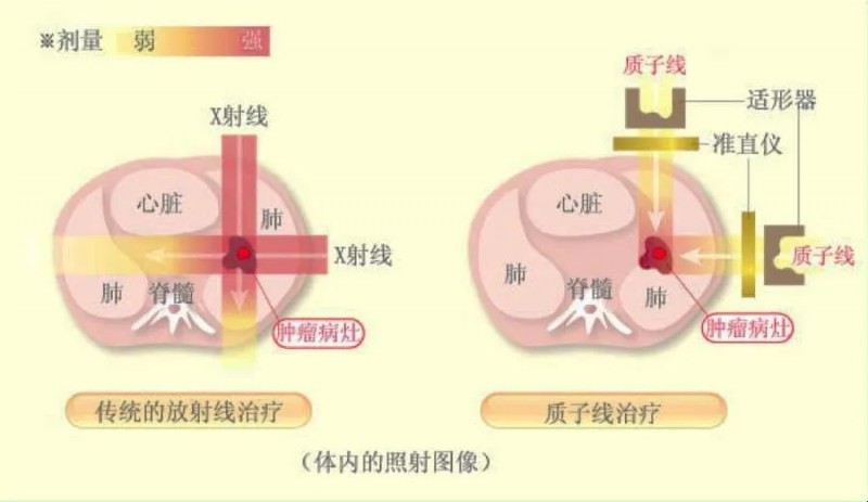 质子束放疗的体内照射图像