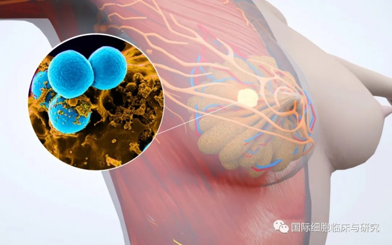 乳腺癌患者营养不良的5种治疗方式，建议收藏！