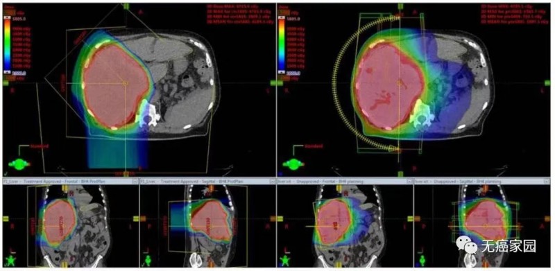 肝癌质子治疗和IMRT治疗的力量对比