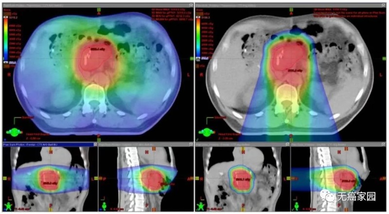 胰腺癌质子放疗和传统X线放疗的剂量对比