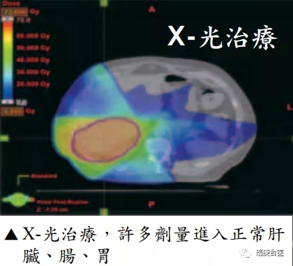 X射线放疗